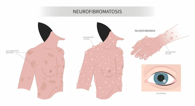 Neurofibromatosis Overview and Treatment Options